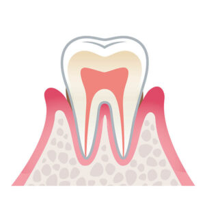 軽度歯周病